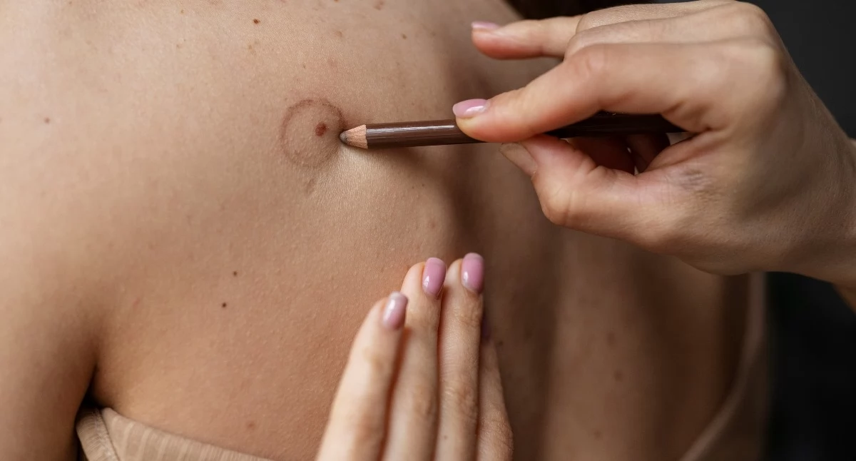 Informator / Materiały zewnętrzne , Znamię zawsze groźne zawsze warto obserwować Kiedy zgłosić dermatologa - zdjęcie, fotografia