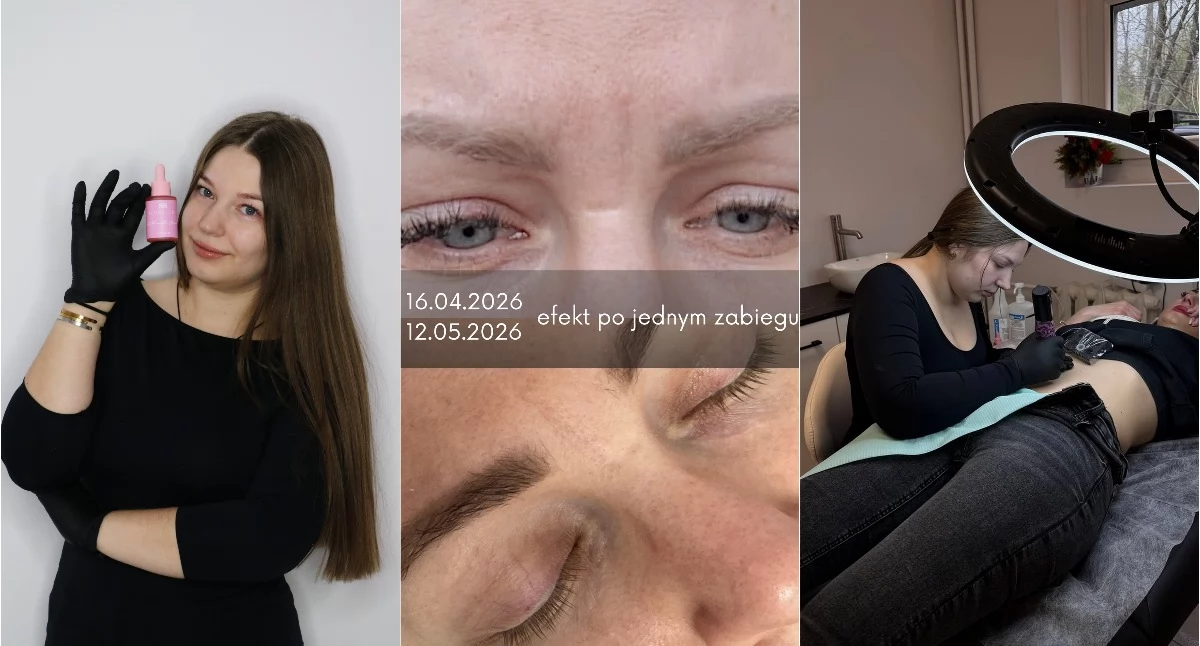 Zdrowie, stare białe rozstępy można jeszcze skutecznie zmniejszyć Nowoczesne podejście regeneracji skóry - zdjęcie, fotografia